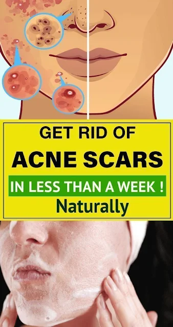 How to Naturally Get Rid of Acne Scars