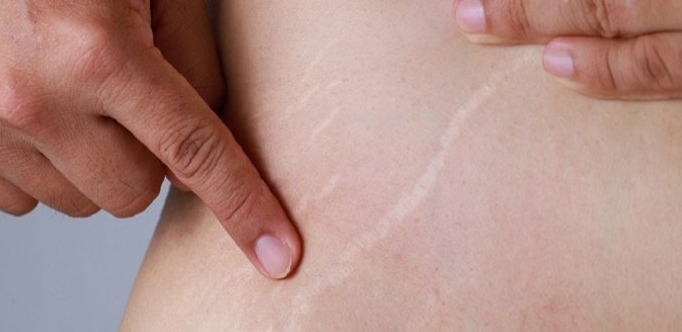 9 Ways to Get Rid of Stretch Marks - try it