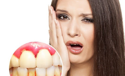 Khi răng bị chảy máu có mùi hôi là bị bệnh gì? 1