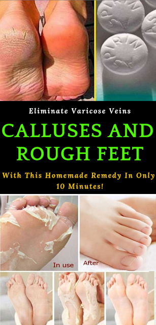 Eliminate Varicose Veins, Calluses and Rough Feet With This Homemade Remedy In Only 10 Minutes!