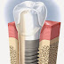 Kerela Dental Care Holidays: Affordable option for dental implants