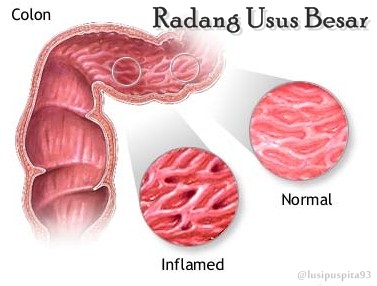 Pengobatan Tradisional untuk Radang Usus Besar Obat 