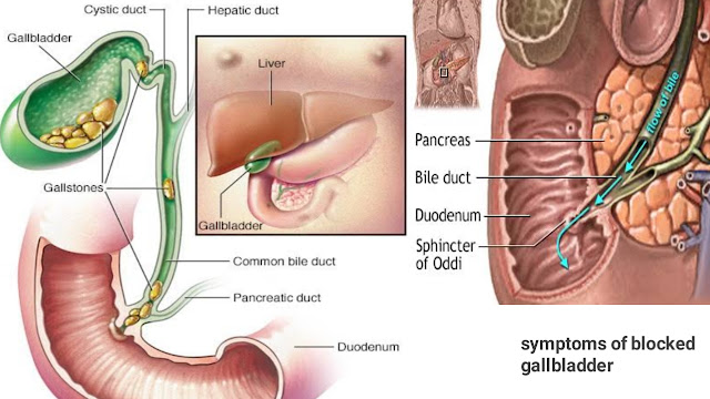 symptoms-of-blocked-gallbladder