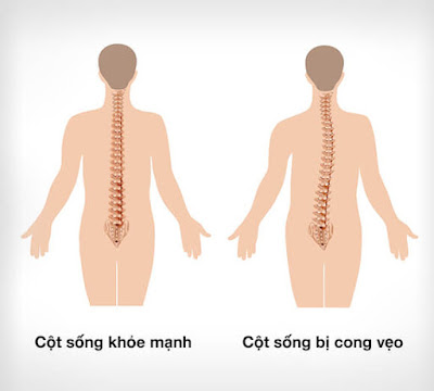 Nguyên nhân chứng cong vẹo cột sống