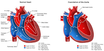 Coarctation of the Aorta (COA)
