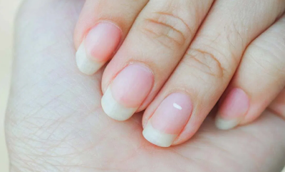 White Spots on Nails: Do you have white spots on your nails too? Caution is a sign of these diseases White Spots on Nails: మీ గోళ్లపై కూడా ఇలా తెల్ల మచ్చలు ఉన్నాయా? జాగ్రత్త ఈ వ్యాధులకు సంకేతం.