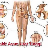 Hb Rendah Asam Urat Tinggi