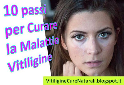 passi-per-curare-la-malattia-vitiligine-rimedi-naturali-efficaci