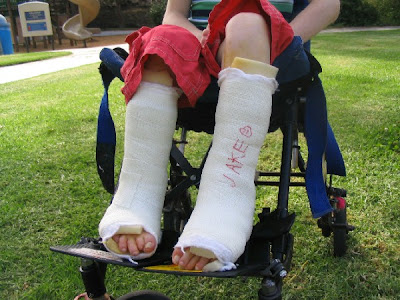 child seated, legs in casts