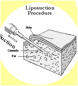 Liposuction Los Angeles