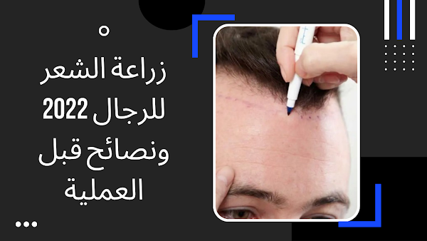 زراعة الشعر للرجال 2022 ونصائح قبل العملية