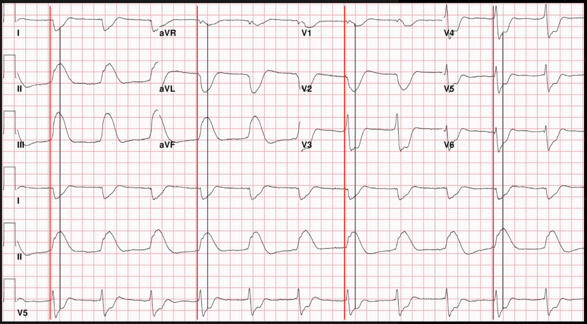 Dr Smith S Ecg Blog Shark Fin A Deadly Ecg Sign That You Must