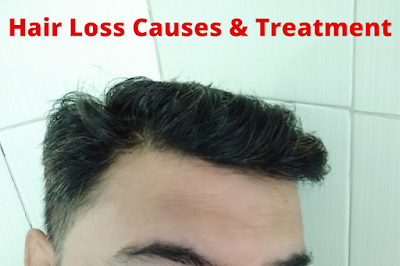 Hair loss causes and treatment