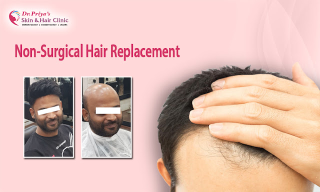 Best Non-Surgical Hair Replacement In Marathahalli