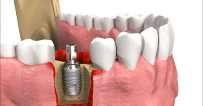 Cấy răng implant bao nhiêu tiền-3