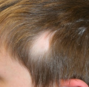 alopecia triangular congénita