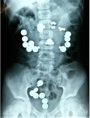 girl from indiana x ray image Foto Hasil Sinar X yang Mengerikan