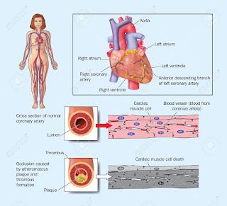   placa de ateroma, placa de ateroma formacion, ateroma calcificado, ateroma tratamiento, proceso de formacion de ateroma, como eliminar placas de ateroma, ateroma calcificado en aorta, sintomas de ateroma, ateroma aortico