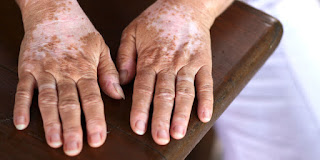 Vitiligo Tratamiento