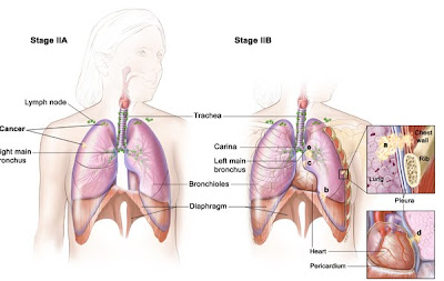 Malignant Mesothelioma Staging,Mesothelioma