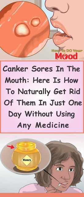 CANKER SORES IN THE MOUTH: HERE IS HOW TO NATURALLY GET RID OF THEM IN JUST ONE DAY WITHOUT USING ANY MEDICINE