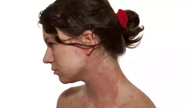 best tips to alleviate eczema symptoms.