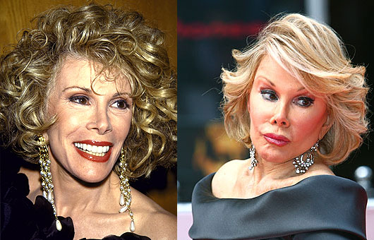 before and after joan rivers