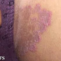 Cara Ampuh menghilangkan luka gatal di selangkangan