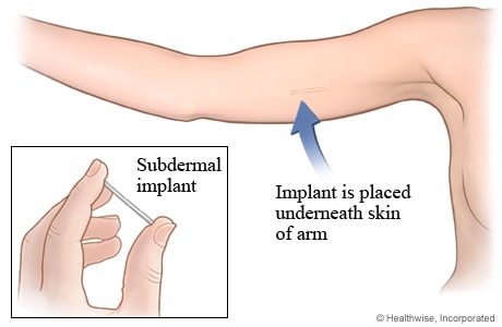 Prosedur Perancang Keluarga - Suntikan, IUD & Implan