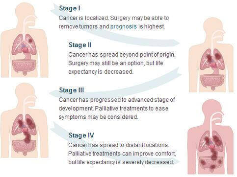 Mesothelioma Stages