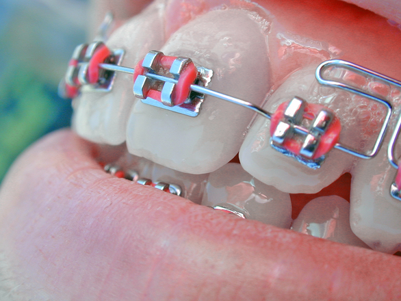 Pemasangan Kawat Gigi atau Pemasangan Behel