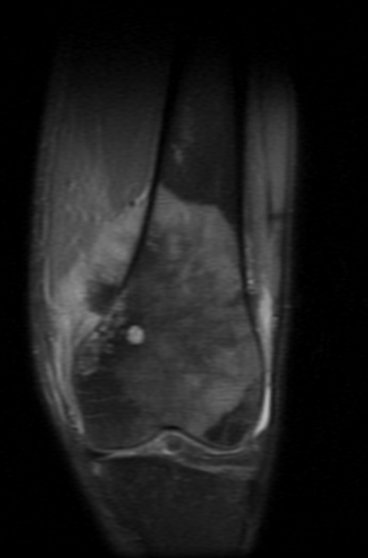 Osteosarcoma Knee - Periosteal Reaction