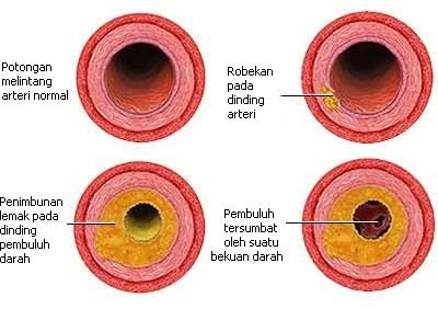 Plak & bekuan darah