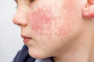 UKHSA replaces scarlet fever and invasive Group A strep