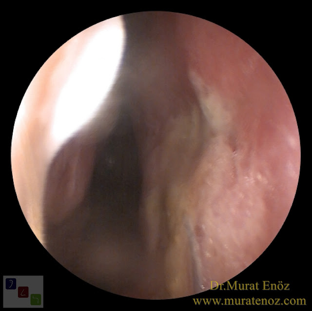 Ekstrakorporeal septum perforasyonu tamiri - Ekstrakorporeal septum perforasyonu ameliyatı - Septum perforasyonu tedavisi - Nazal septum perforasyonu operasyonu - Açık teknik ekstrakorporeal septum perforasyonu ameliyatı - Açık teknik ekstrakorporeal septum perforasyonu onarımı - Burun estetiği ile birlikte ekstrakorporeal septum perforasyonu kapatılması - Ekstrakorporeal burun septumunda delik kapatılması - Burunda delik oluşumu - Burun duvarında delik - Burun kıkırdak delinmesi tedavisi - Septum perforasyonu ameliyatı olanlar - Septum perforasyonu olanlar - Septal perforasyon tamiri - Ekstrakorporeal burun septum perforasyonu ameliyatı - Extracorporeal septum perforation closure in Istanbul - Extracorporeal septum perforation closure in Turkey - Extracorporeal closure of nasal septal perforations subcutaneous tissue - Combining rhinoplasty with extracorporeal septal perforation repair