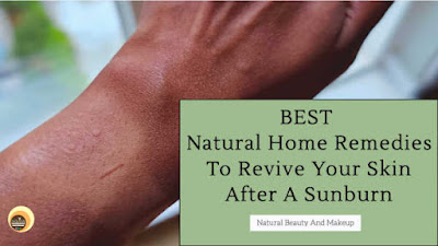 best natural home remedies to revive your skin after a sunburn
