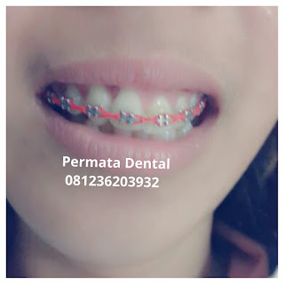 gambar foto behel bracket kawat gigi sebelum dan sesudah perawatan untuk memperbaiki merapikan gigi gingsul gigi miring renggang tonggos berantakan keluar masuk jarang diastema maju mundur tidak rapi tidak beraturan bali denpasar banyuwangi jember tidak rata kocar kacir