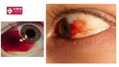 What Is Subconjunctival Hemorrhage (Broken Blood Vessel In Eye)?
