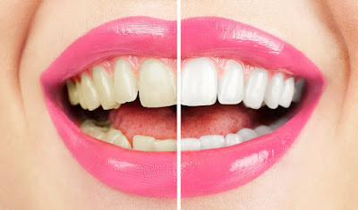 Teeth whitening before and after