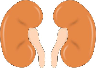 what is the cause of kidney stones