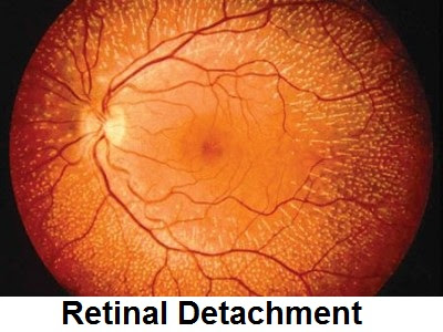 Retinal Detachment: Causes, Symptoms, Diagnosis And Treatment