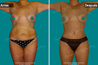 Abdominoplastia-rejuvenecimiento-Corporal