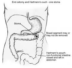 Hartmann opn left side colon career sized