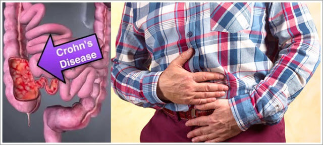 Obat Crohn's Disease Atau Penyakit Crohn Herbal Terbaik