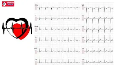 What is Tachycardia?