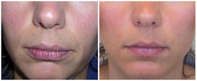 Lip Augmentation Before And After