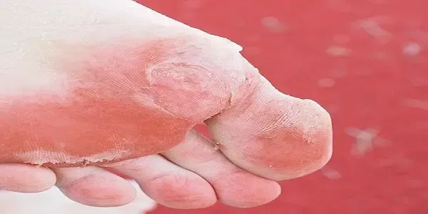 causes and treatment of foot fungus