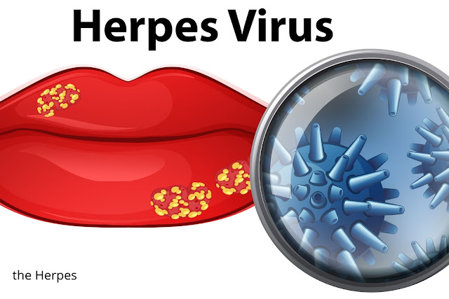 Herpes Virus - Treat of Herpes Virus?