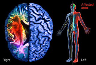Stroke, Gangguan Otak Kanan dan Otak Kiri, Tes Otak Kanan dan Otak Kiri, Apa yang Terjadi Jika Otak Kanan atau Otak Kiri Kita Mengalami Gangguan
