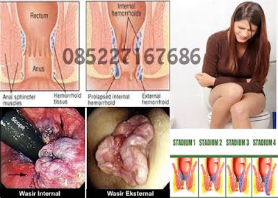  Jus buah untuk meredakan wasir